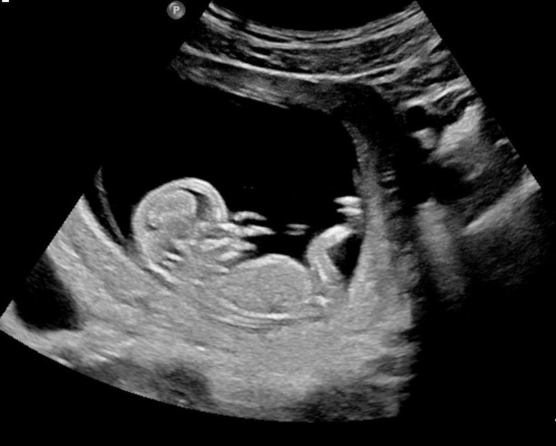 An ultrasound profile view of a baby in the womb